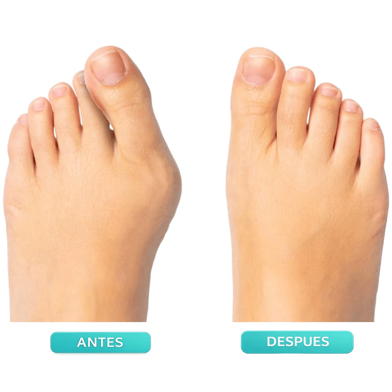 Father's Day Deal 👣Adjustable Bunion Corrector