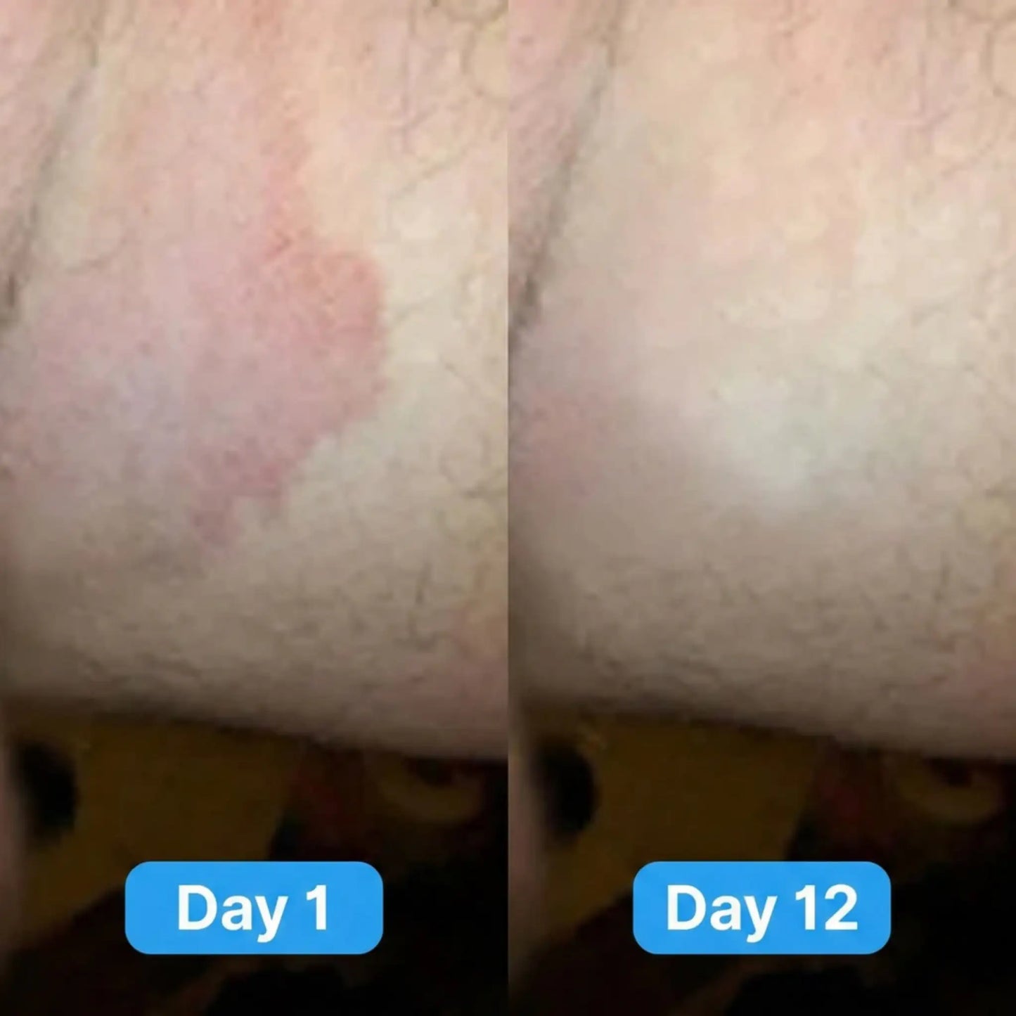 Sumifun Antifungal Cream®