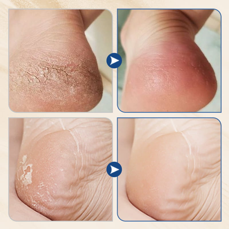 🔥Hot sale 49% off🔥 Hydrating and Anti-Cracking Foot Cream